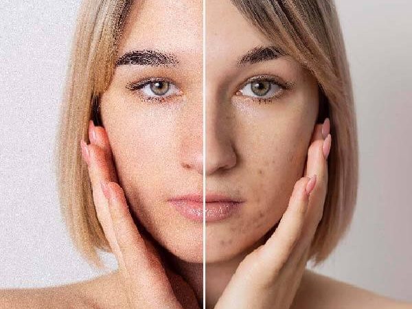 6 مرحله حرفه ای مبارزه با لک های پوستی